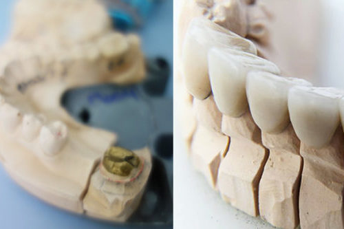 Dental Crowns & Veneers